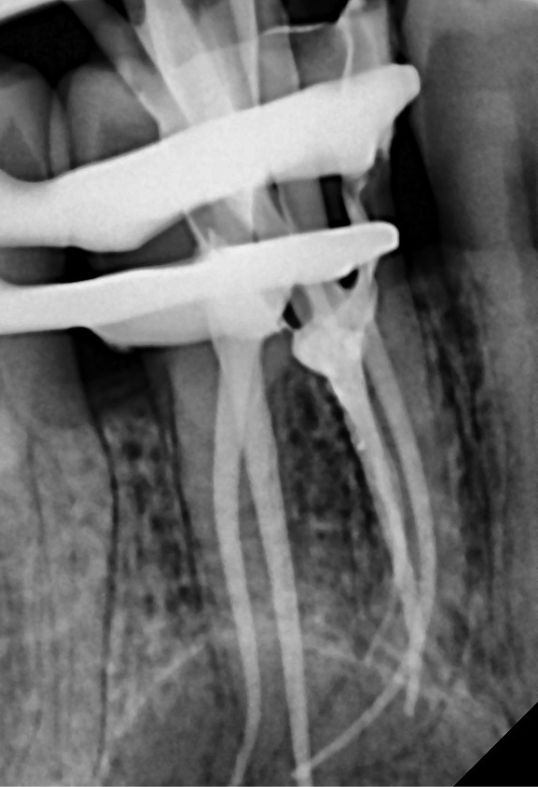Endodoncia MURCIA