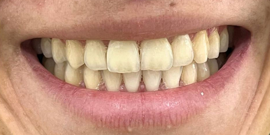 Situación previa al blanqueamiento dental