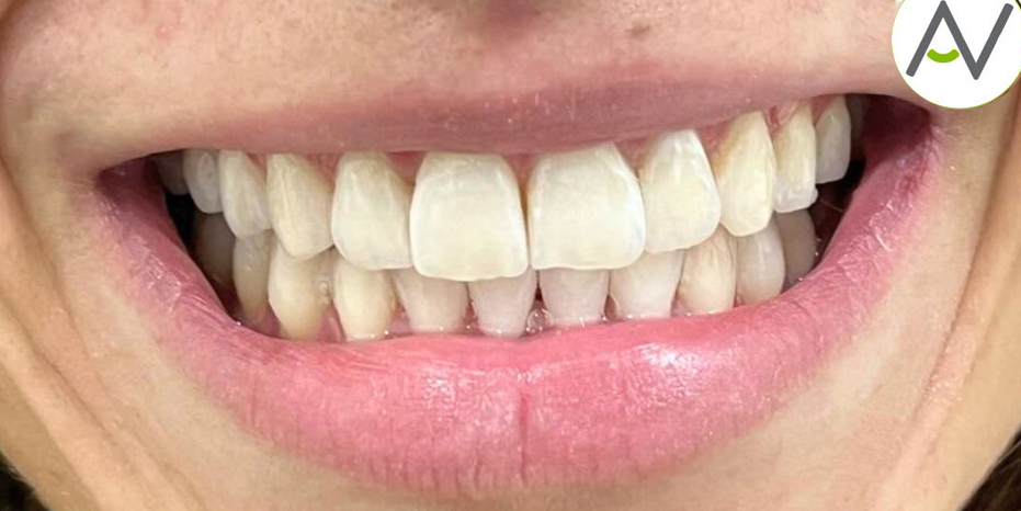 Resultado de blanqueamiento dental Philips Zoom en Murcia