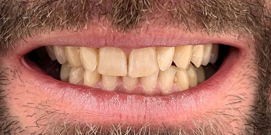 Antes de blanqueamiento dental Philips Zoom