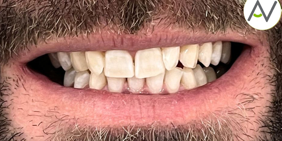 Resultado después de blanqueamiento dental Philips Zoom