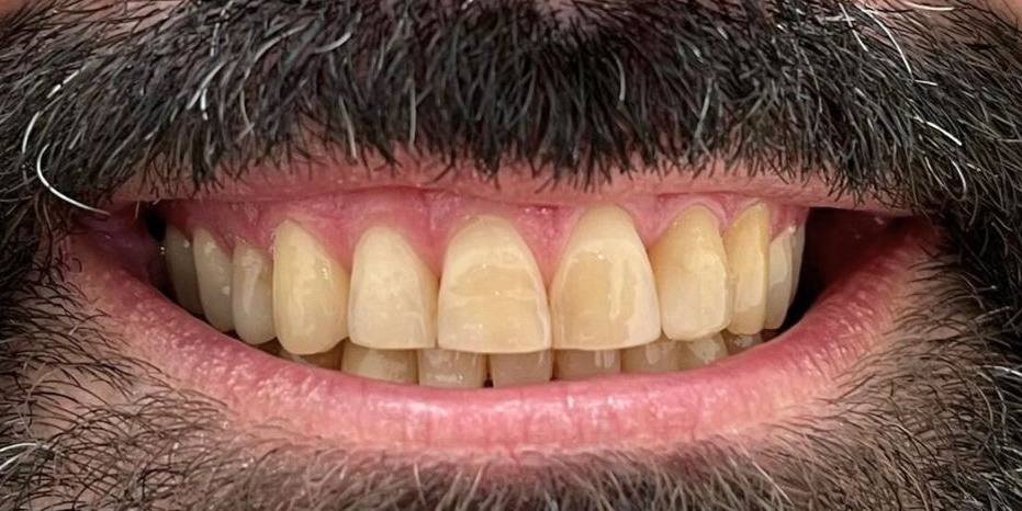 Antes del tratamiento profesional de blanqueamiento dental