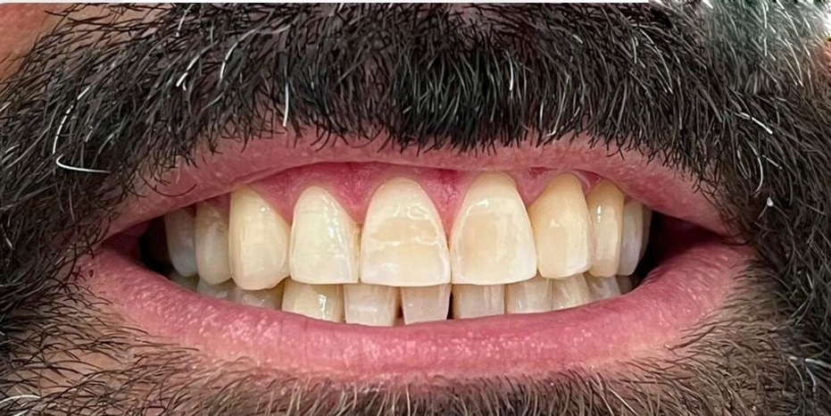 Resultado de tratamiento profesional de blanqueamiento dental