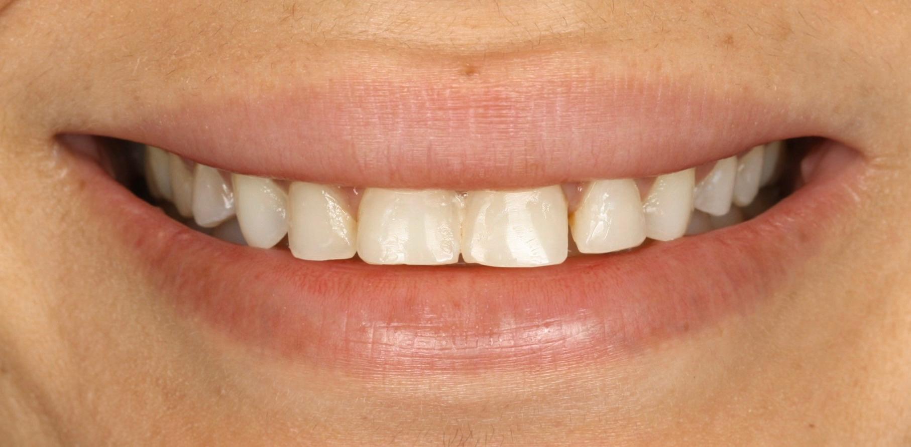 Resultado dental tras el tratamiento estético