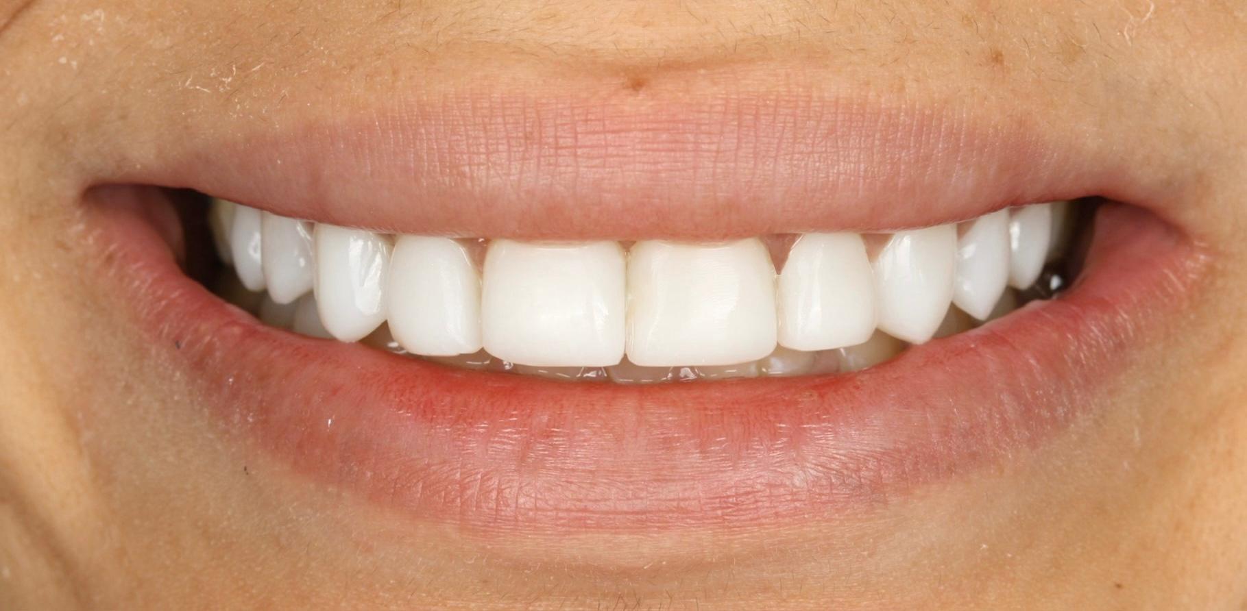 Estado anterior de la sonrisa antes del tratamiento