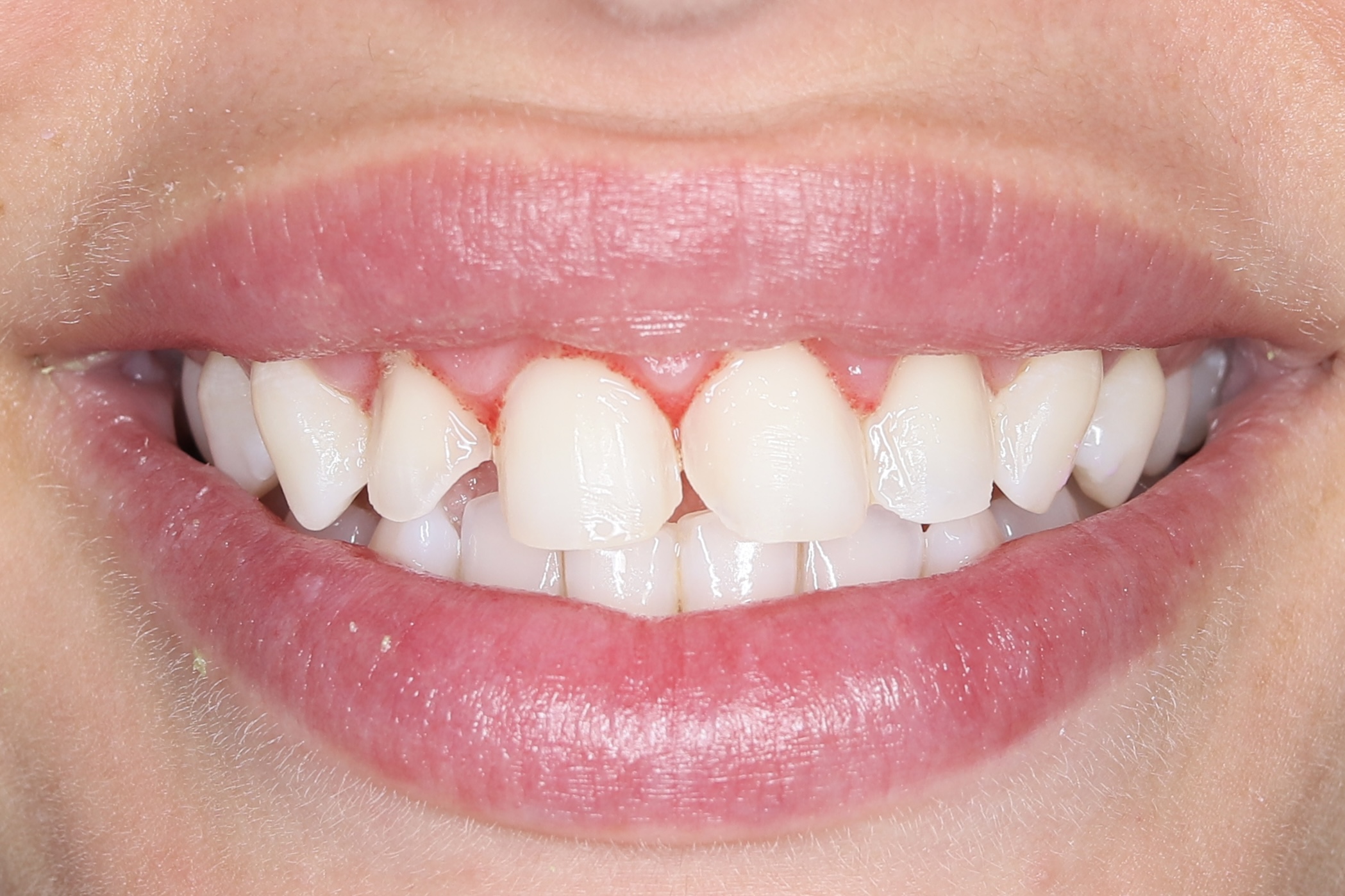 Resultado estético dental después del tratamiento