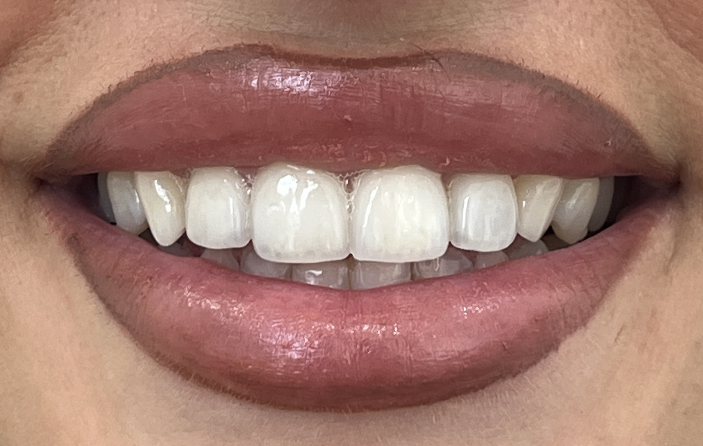 Situación dental previa al tratamiento estético
