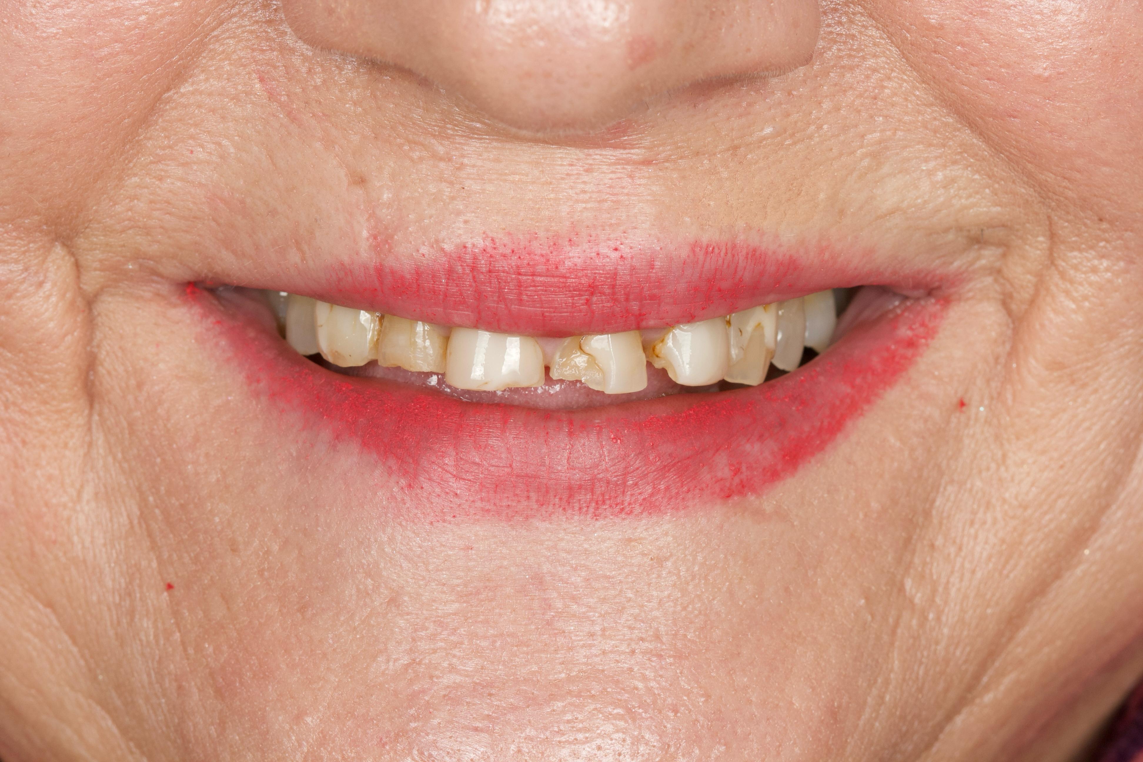 Situación dental previa al tratamiento estético