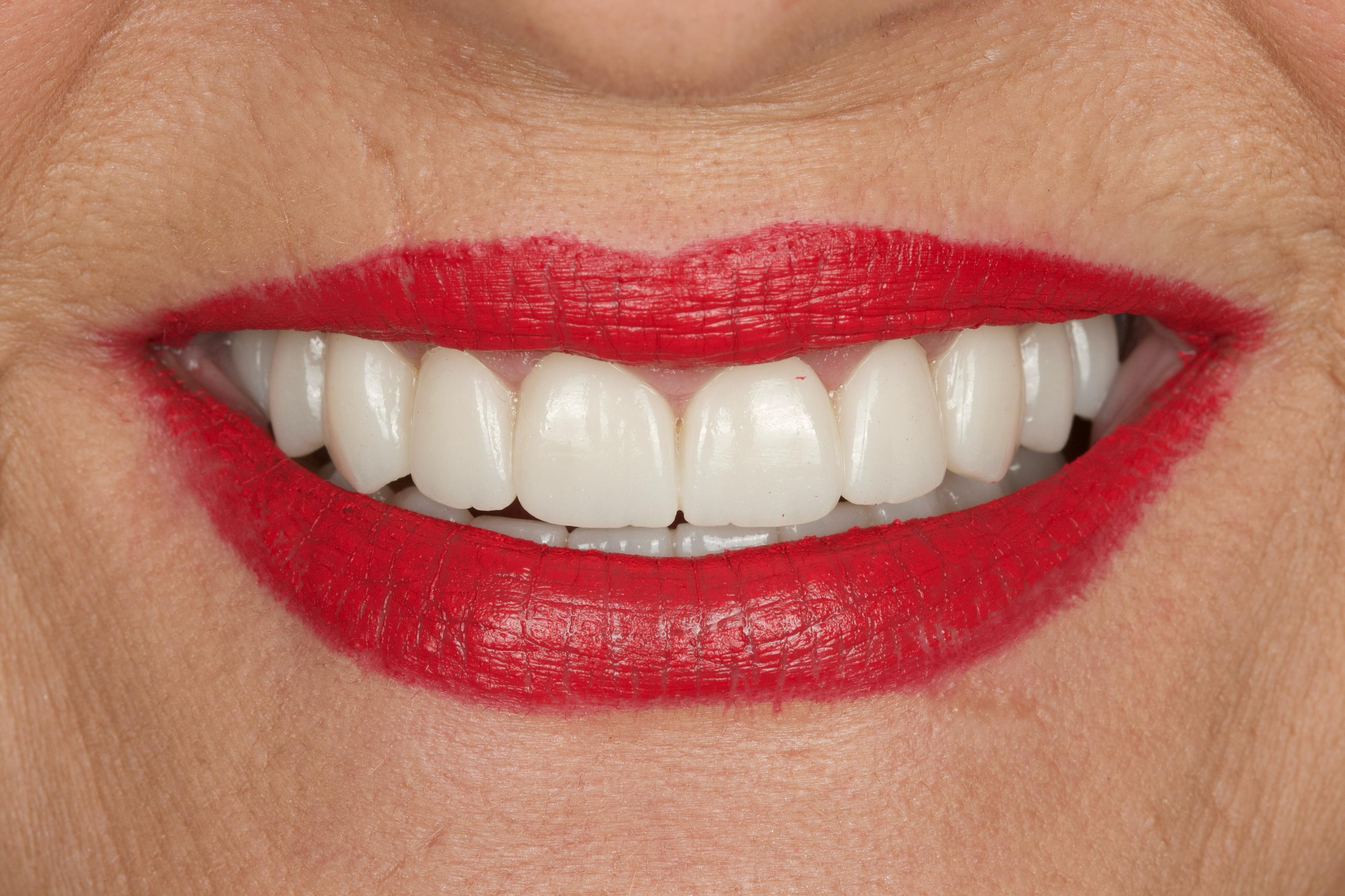 Resultado estético dental después del tratamiento