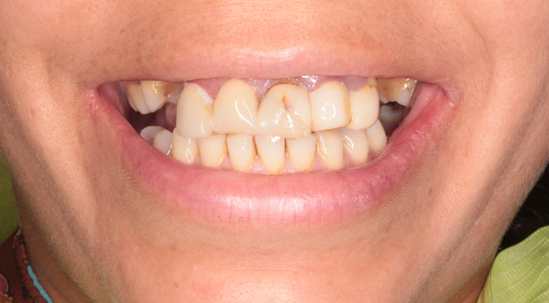 Situación previa al tratamiento con implantes dentales