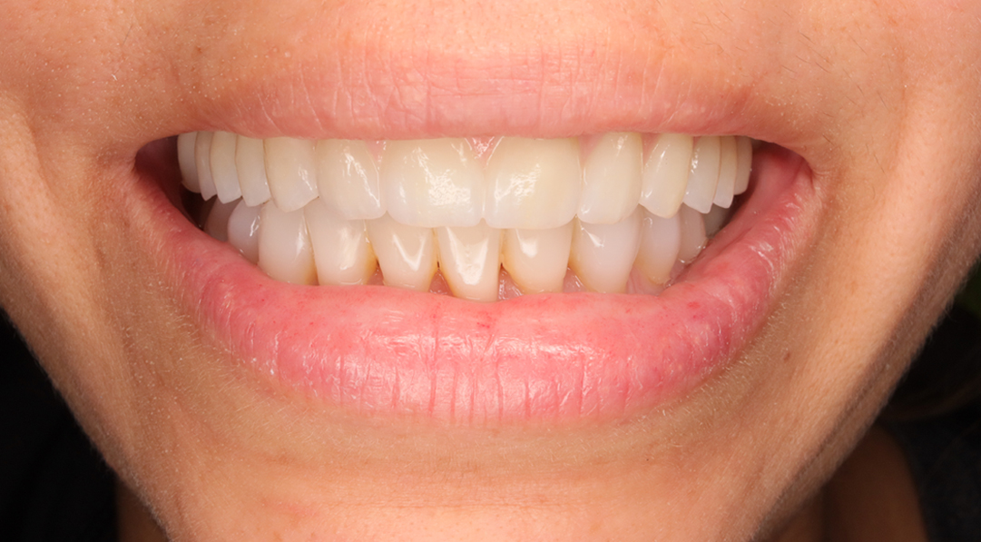 Resultado de tratamiento con implantes dentales en Murcia