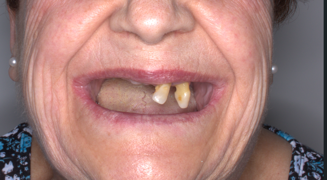 Resultado de rehabilitación fija superior e inferior con implantes dentales