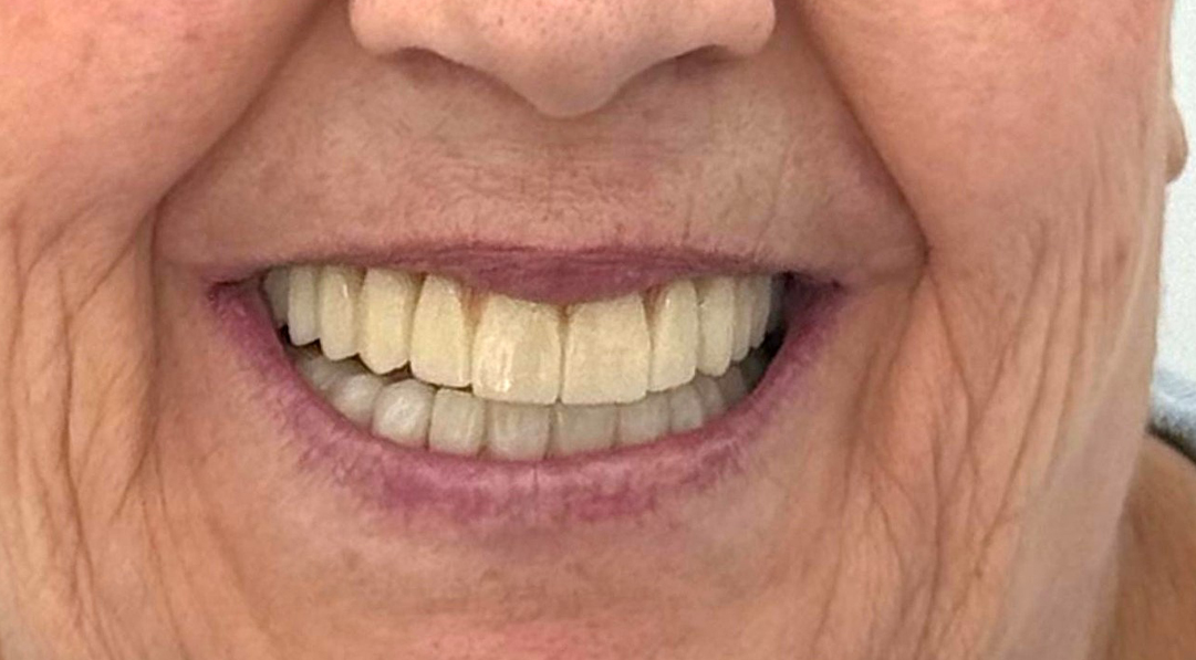 Situación previa a rehabilitación con implantes dentales