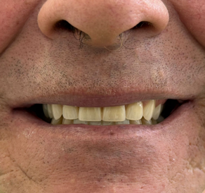Situación previa al tratamiento con implantes dentales