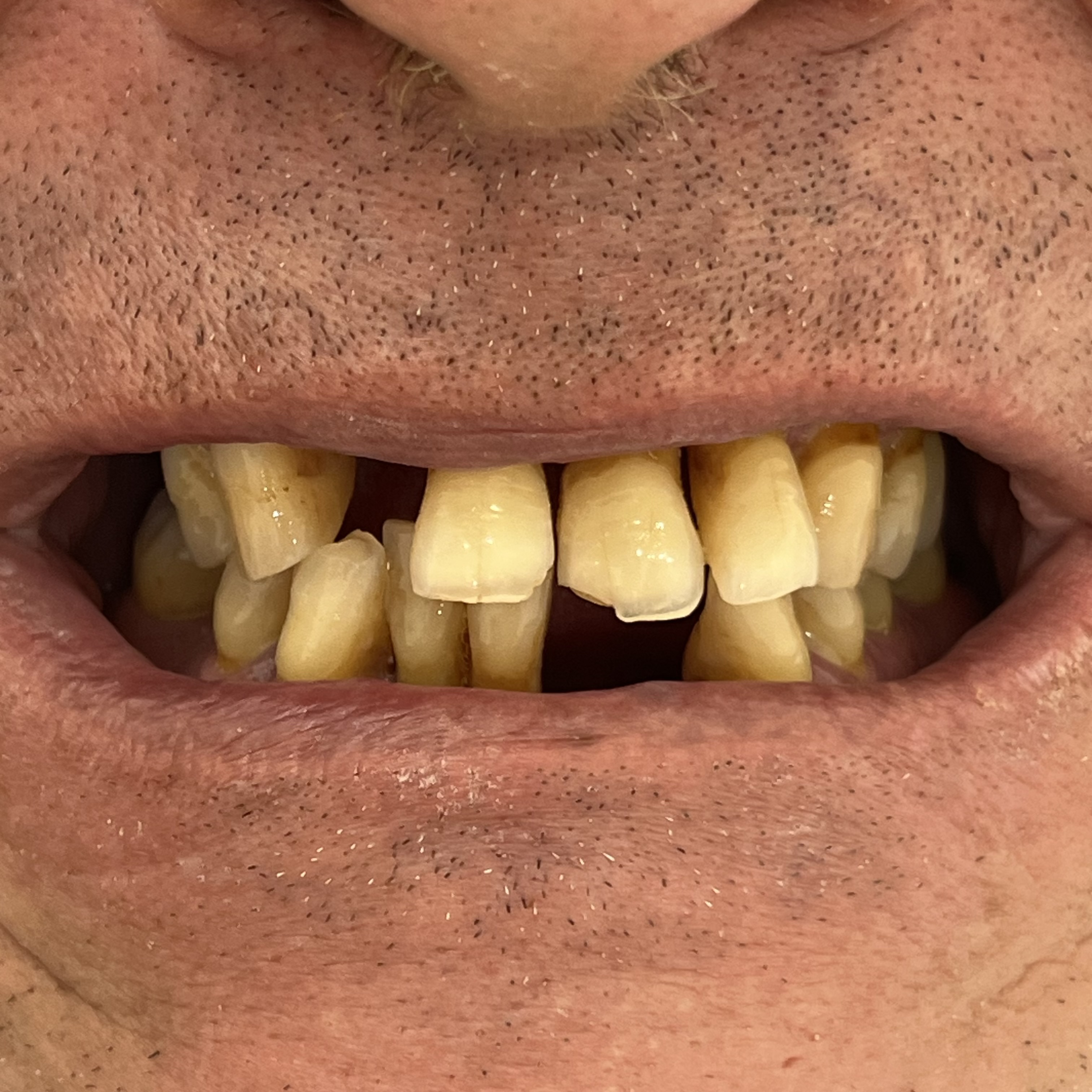 Resultado de tratamiento con sobredentadura sobre implantes dentales