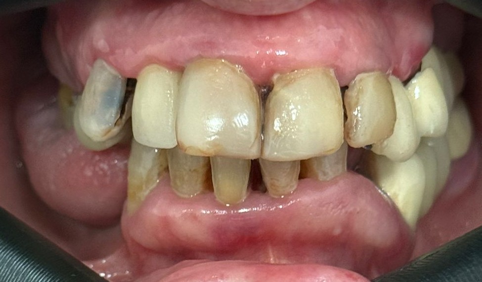 Situación previa a rehabilitación fija con implantes dentales