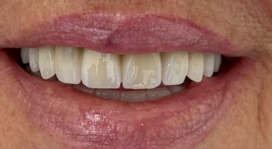 Resultado de rehabilitación fija con implantes dentales en Murcia